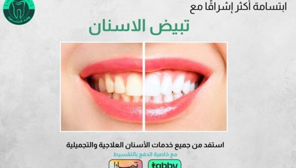 عروض تبييض الأسنان