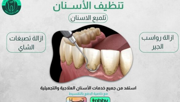 عروض تنظيف الأسنان