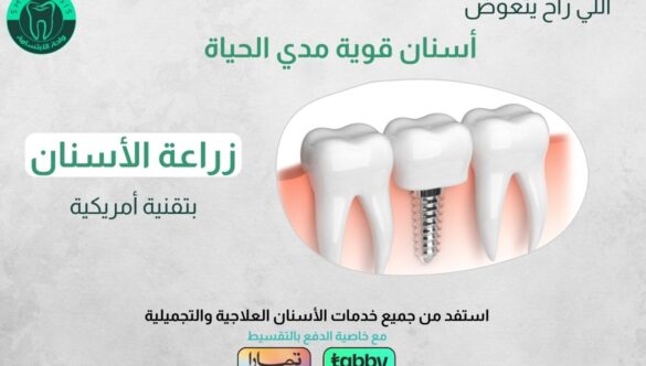 عروض زراعة الأسنان